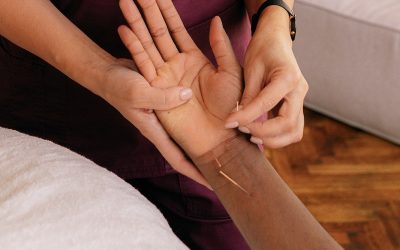 Acupuncture for Carpal Tunnel Syndrome